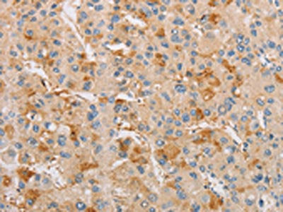 The image on the left is immunohistochemistry of paraffin-embedded Human liver cancer tissue using CSB-PA120422(ARSF Antibody) at dilution 1/20, on the right is treated with fusion protein. (Original magnification: ×200)
