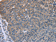 The image on the left is immunohistochemistry of paraffin-embedded Human lung cancer tissue using CSB-PA120564(GNAI3 Antibody) at dilution 1/30, on the right is treated with fusion protein. (Original magnification: ×200)