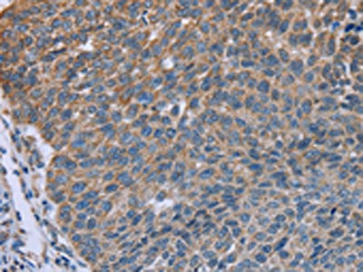 The image on the left is immunohistochemistry of paraffin-embedded Human lung cancer tissue using CSB-PA120564(GNAI3 Antibody) at dilution 1/30, on the right is treated with fusion protein. (Original magnification: ×200)