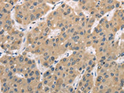 The image on the left is immunohistochemistry of paraffin-embedded Human liver cancer tissue using CSB-PA120599(TRIB3 Antibody) at dilution 1/30, on the right is treated with fusion protein. (Original magnification: ×200)