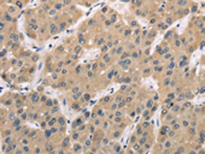 The image on the left is immunohistochemistry of paraffin-embedded Human liver cancer tissue using CSB-PA120599(TRIB3 Antibody) at dilution 1/30, on the right is treated with fusion protein. (Original magnification: ×200)