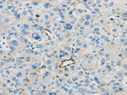 The image on the left is immunohistochemistry of paraffin-embedded Human liver cancer tissue using CSB-PA120615(CD63 Antibody) at dilution 1/35, on the right is treated with synthetic peptide. (Original magnification: ×200)