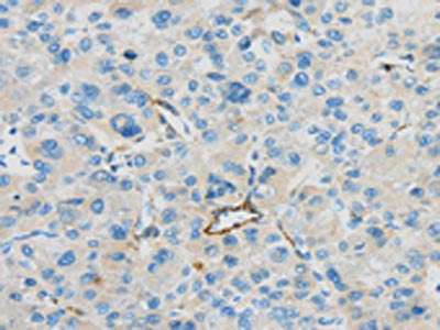 The image on the left is immunohistochemistry of paraffin-embedded Human liver cancer tissue using CSB-PA120615(CD63 Antibody) at dilution 1/35, on the right is treated with synthetic peptide. (Original magnification: ×200)
