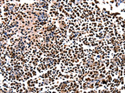 The image on the left is immunohistochemistry of paraffin-embedded Human tonsil tissue using CSB-PA120655(HDAC1 Antibody) at dilution 1/5, on the right is treated with fusion protein. (Original magnification: ×200)