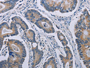 The image on the left is immunohistochemistry of paraffin-embedded Human colon cancer tissue using CSB-PA120772(NOX1 Antibody) at dilution 1/40, on the right is treated with synthetic peptide. (Original magnification: ×200)