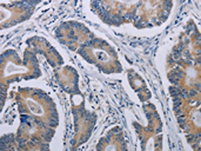 The image on the left is immunohistochemistry of paraffin-embedded Human colon cancer tissue using CSB-PA120772(NOX1 Antibody) at dilution 1/40, on the right is treated with synthetic peptide. (Original magnification: ×200)