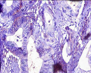 Immunohistochemistry of paraffin-embedded human colon cancer using CSB-PA12077A0Rb at dilution of 1:10