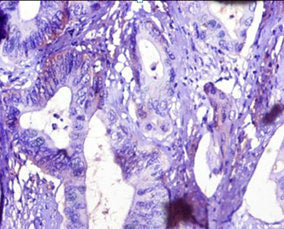 Immunohistochemistry of paraffin-embedded human colon cancer using CSB-PA12077A0Rb at dilution of 1:10