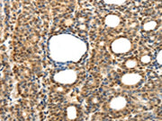The image on the left is immunohistochemistry of paraffin-embedded Human thyroid cancer tissue using CSB-PA120806(SYT7 Antibody) at dilution 1/15, on the right is treated with fusion protein. (Original magnification: ×200)