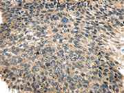 The image on the left is immunohistochemistry of paraffin-embedded Human esophagus cancer tissue using CSB-PA120935(USP9X Antibody) at dilution 1/35, on the right is treated with synthetic peptide. (Original magnification: ×200)