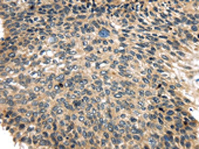 The image on the left is immunohistochemistry of paraffin-embedded Human esophagus cancer tissue using CSB-PA120935(USP9X Antibody) at dilution 1/35, on the right is treated with synthetic peptide. (Original magnification: ×200)