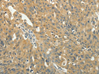 The image on the left is immunohistochemistry of paraffin-embedded Human ovarian cancer tissue using CSB-PA121037(TAGLN2 Antibody) at dilution 1/40, on the right is treated with fusion protein. (Original magnification: ×200)