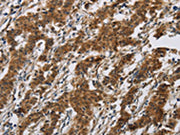 The image on the left is immunohistochemistry of paraffin-embedded Human gastic cancer tissue using CSB-PA121041(IL17RB Antibody) at dilution 1/40, on the right is treated with synthetic peptide. (Original magnification: ×200)