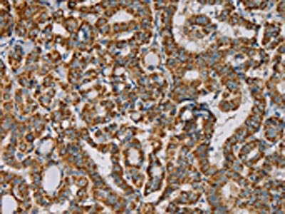 The image on the left is immunohistochemistry of paraffin-embedded Human thyroid cancer tissue using CSB-PA121059(IPO13 Antibody) at dilution 1/25, on the right is treated with fusion protein. (Original magnification: ×200)