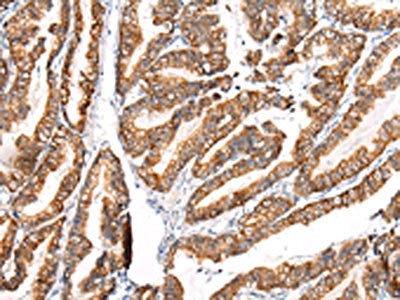 The image on the left is immunohistochemistry of paraffin-embedded Human esophagus cancer tissue using CSB-PA121148(KRT7 Antibody) at dilution 1/20, on the right is treated with synthetic peptide. (Original magnification: ×200)