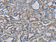 The image on the left is immunohistochemistry of paraffin-embedded Human thyroid cancer tissue using CSB-PA121181(NDUFS7 Antibody) at dilution 1/20, on the right is treated with fusion protein. (Original magnification: ×200)