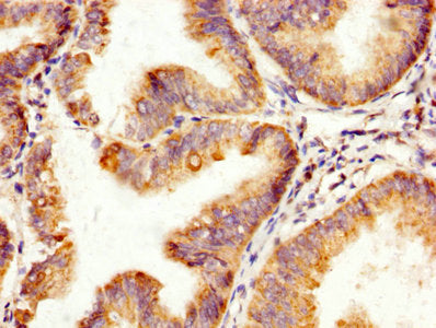IHC image of CSB-PA12124A0Rb diluted at 1:200 and staining in paraffin-embedded human endometrial cancer performed on a Leica BondTM system. After dewaxing and hydration, antigen retrieval was mediated by high pressure in a citrate buffer (pH 6.0)...