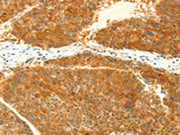The image on the left is immunohistochemistry of paraffin-embedded Human liver cancer tissue using CSB-PA121487(NAPA Antibody) at dilution 1/25, on the right is treated with fusion protein. (Original magnification: ×200)