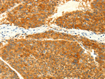 The image on the left is immunohistochemistry of paraffin-embedded Human liver cancer tissue using CSB-PA121487(NAPA Antibody) at dilution 1/25, on the right is treated with fusion protein. (Original magnification: ×200)