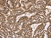 The image on the left is immunohistochemistry of paraffin-embedded Human thyroid cancer tissue using CSB-PA121495(PPOX Antibody) at dilution 1/40, on the right is treated with synthetic peptide. (Original magnification: ×200)