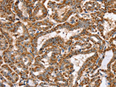 The image on the left is immunohistochemistry of paraffin-embedded Human thyroid cancer tissue using CSB-PA121495(PPOX Antibody) at dilution 1/40, on the right is treated with synthetic peptide. (Original magnification: ×200)