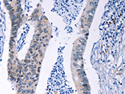The image on the left is immunohistochemistry of paraffin-embedded Human colon cancer tissue using CSB-PA121578(HMGB3 Antibody) at dilution 1/20, on the right is treated with synthetic peptide. (Original magnification: ×200)