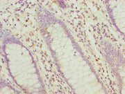 Immunohistochemistry of paraffin-embedded human colon cancer using CSB-PA12159A0Rb at dilution of 1:100