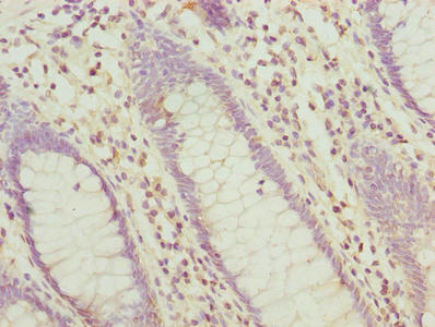 Immunohistochemistry of paraffin-embedded human colon cancer using CSB-PA12159A0Rb at dilution of 1:100