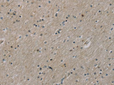 The image on the left is immunohistochemistry of paraffin-embedded Human brain tissue using CSB-PA121728(ROBO4 Antibody) at dilution 1/25, on the right is treated with fusion protein. (Original magnification: ×200)