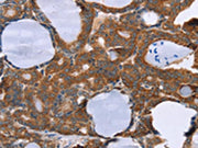 The image on the left is immunohistochemistry of paraffin-embedded Human thyroid cancer tissue using CSB-PA121814(PITPNM1 Antibody) at dilution 1/40, on the right is treated with fusion protein. (Original magnification: ×200)