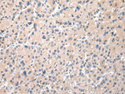 The image on the left is immunohistochemistry of paraffin-embedded Human liver cancer tissue using CSB-PA121890(TXNDC11 Antibody) at dilution 1/50, on the right is treated with fusion protein. (Original magnification: ×200)