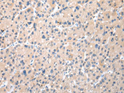 The image on the left is immunohistochemistry of paraffin-embedded Human liver cancer tissue using CSB-PA121890(TXNDC11 Antibody) at dilution 1/50, on the right is treated with fusion protein. (Original magnification: ×200)