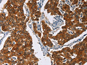 The image on the left is immunohistochemistry of paraffin-embedded Human breast cancer tissue using CSB-PA121899(CRABP2 Antibody) at dilution 1/40, on the right is treated with fusion protein. (Original magnification: ×200)
