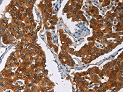 The image on the left is immunohistochemistry of paraffin-embedded Human breast cancer tissue using CSB-PA121899(CRABP2 Antibody) at dilution 1/40, on the right is treated with fusion protein. (Original magnification: ×200)