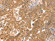The image on the left is immunohistochemistry of paraffin-embedded Human breast cancer tissue using CSB-PA121989(RPS6KA1 Antibody) at dilution 1/30, on the right is treated with fusion protein. (Original magnification: ×200)