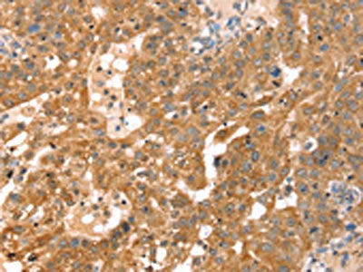 The image on the left is immunohistochemistry of paraffin-embedded Human breast cancer tissue using CSB-PA121989(RPS6KA1 Antibody) at dilution 1/30, on the right is treated with fusion protein. (Original magnification: ×200)