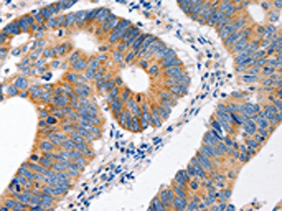 The image on the left is immunohistochemistry of paraffin-embedded Human colon cancer tissue using CSB-PA122172(MC1R Antibody) at dilution 1/100, on the right is treated with synthetic peptide. (Original magnification: ×200)