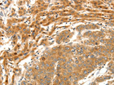 The image on the left is immunohistochemistry of paraffin-embedded Human breast cancer tissue using CSB-PA122189(SERPINE1 Antibody) at dilution 1/20, on the right is treated with fusion protein. (Original magnification: ×200)