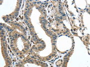 The image on the left is immunohistochemistry of paraffin-embedded Human thyroid cancer tissue using CSB-PA122476(VSIG10 Antibody) at dilution 1/35, on the right is treated with synthetic peptide. (Original magnification: ×200)