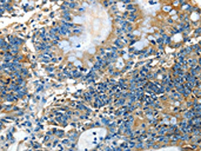 The image on the left is immunohistochemistry of paraffin-embedded Human colon cancer tissue using CSB-PA122487(ADCK4 Antibody) at dilution 1/25, on the right is treated with fusion protein. (Original magnification: ×200)