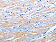 The image on the left is immunohistochemistry of paraffin-embedded Human colon cancer tissue using CSB-PA122612(EPHA1 Antibody) at dilution 1/25, on the right is treated with synthetic peptide. (Original magnification: ×200)