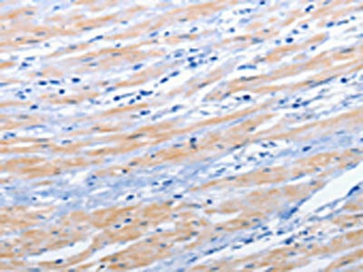 The image on the left is immunohistochemistry of paraffin-embedded Human colon cancer tissue using CSB-PA122612(EPHA1 Antibody) at dilution 1/25, on the right is treated with synthetic peptide. (Original magnification: ×200)