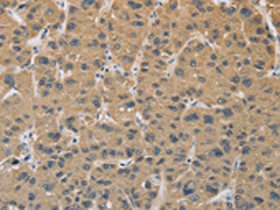 The image on the left is immunohistochemistry of paraffin-embedded Human liver cancer tissue using CSB-PA122670(CYFIP2 Antibody) at dilution 1/25, on the right is treated with fusion protein. (Original magnification: ×200)
