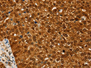 The image on the left is immunohistochemistry of paraffin-embedded Human breast cancer tissue using CSB-PA122817(RAN Antibody) at dilution 1/20, on the right is treated with fusion protein. (Original magnification: ×200)