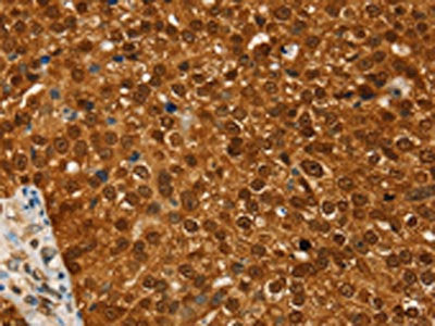 The image on the left is immunohistochemistry of paraffin-embedded Human breast cancer tissue using CSB-PA122817(RAN Antibody) at dilution 1/20, on the right is treated with fusion protein. (Original magnification: ×200)