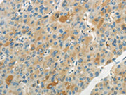 The image on the left is immunohistochemistry of paraffin-embedded Human liver cancer tissue using CSB-PA122866(WNT2B Antibody) at dilution 1/20, on the right is treated with synthetic peptide. (Original magnification: ×200)
