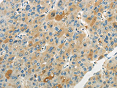 The image on the left is immunohistochemistry of paraffin-embedded Human liver cancer tissue using CSB-PA122866(WNT2B Antibody) at dilution 1/20, on the right is treated with synthetic peptide. (Original magnification: ×200)