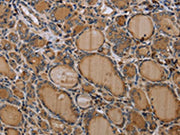 The image on the left is immunohistochemistry of paraffin-embedded Human thyroid cancer tissue using CSB-PA123062(NLRP4 Antibody) at dilution 1/30, on the right is treated with synthetic peptide. (Original magnification: ×200)