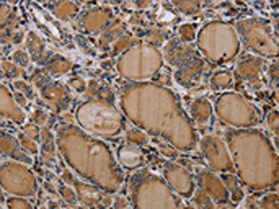 The image on the left is immunohistochemistry of paraffin-embedded Human thyroid cancer tissue using CSB-PA123062(NLRP4 Antibody) at dilution 1/30, on the right is treated with synthetic peptide. (Original magnification: ×200)
