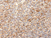 The image on the left is immunohistochemistry of paraffin-embedded Human liver cancer tissue using CSB-PA123199(ZNF365 Antibody) at dilution 1/20, on the right is treated with synthetic peptide. (Original magnification: ×200)